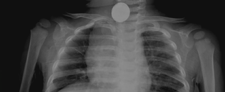 Foreign object stuck in someones throat during an xray